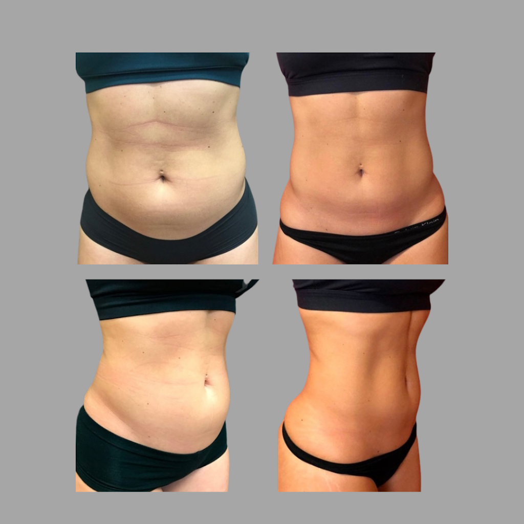 new-laser-clinic-fjernelse-af-tatoveringer-emsculpting-13.jpeg