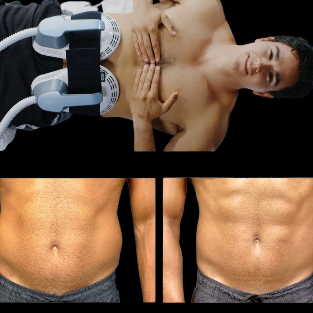 new-laser-clinic-fjernelse-af-tatoveringer-emsculpting-18.jpeg